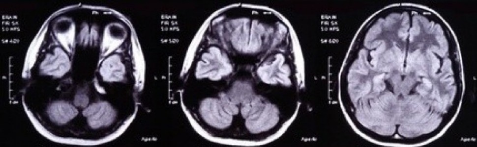 Diagnozowanie i metody leczenia płynotoku pourazowego