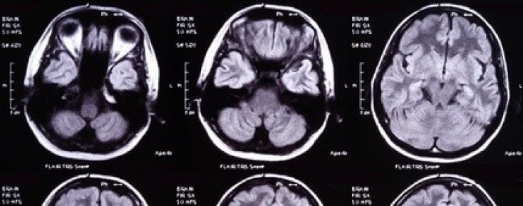 Diagnozowanie i metody leczenia płynotoku pourazowego
