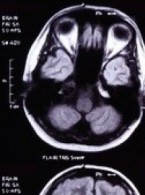Diagnozowanie i metody leczenia płynotoku pourazowego